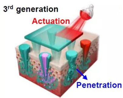 第三代：通过微针介导的皮肤层破坏和微针伴随的各种功能增强药物转运.jpg
